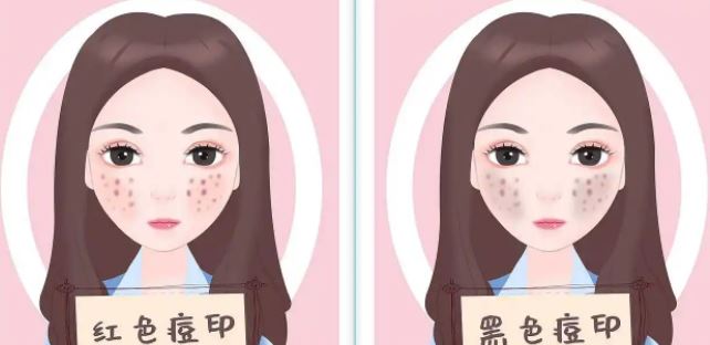 臉上紅色痘印幾個月都不消怎么辦？紅色痘印應(yīng)該怎么消除？